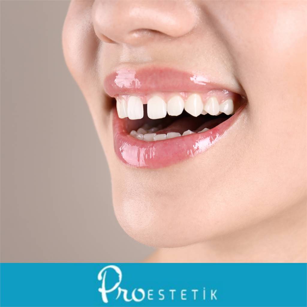 Diastema (Ayrık Diş) Nedir? Tedavi Yöntemleri Nelerdir?