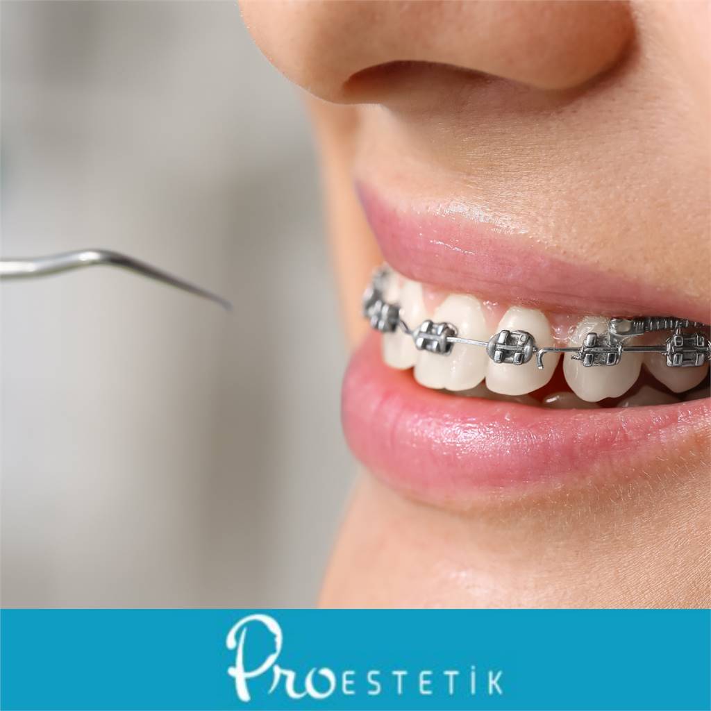 Braket Nedir? Diş Teli Çeşitleri Nelerdir?
