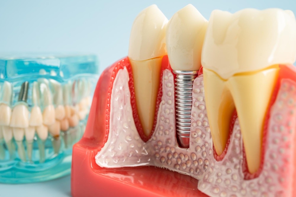 İmplant Çevresi İltihabı (Peri-implantitis) Nedir, Nasıl Önlenir?
