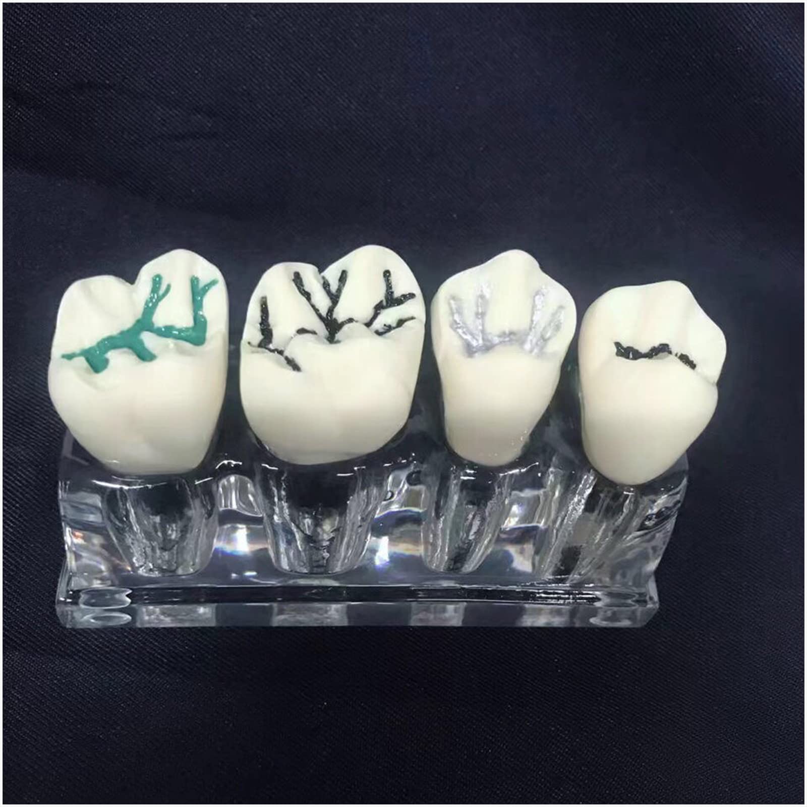 İnvisible Fillings: Dişin Anatomik Çukur ve Tümseklerin (Fissürleri) Taklit Eden Sanat