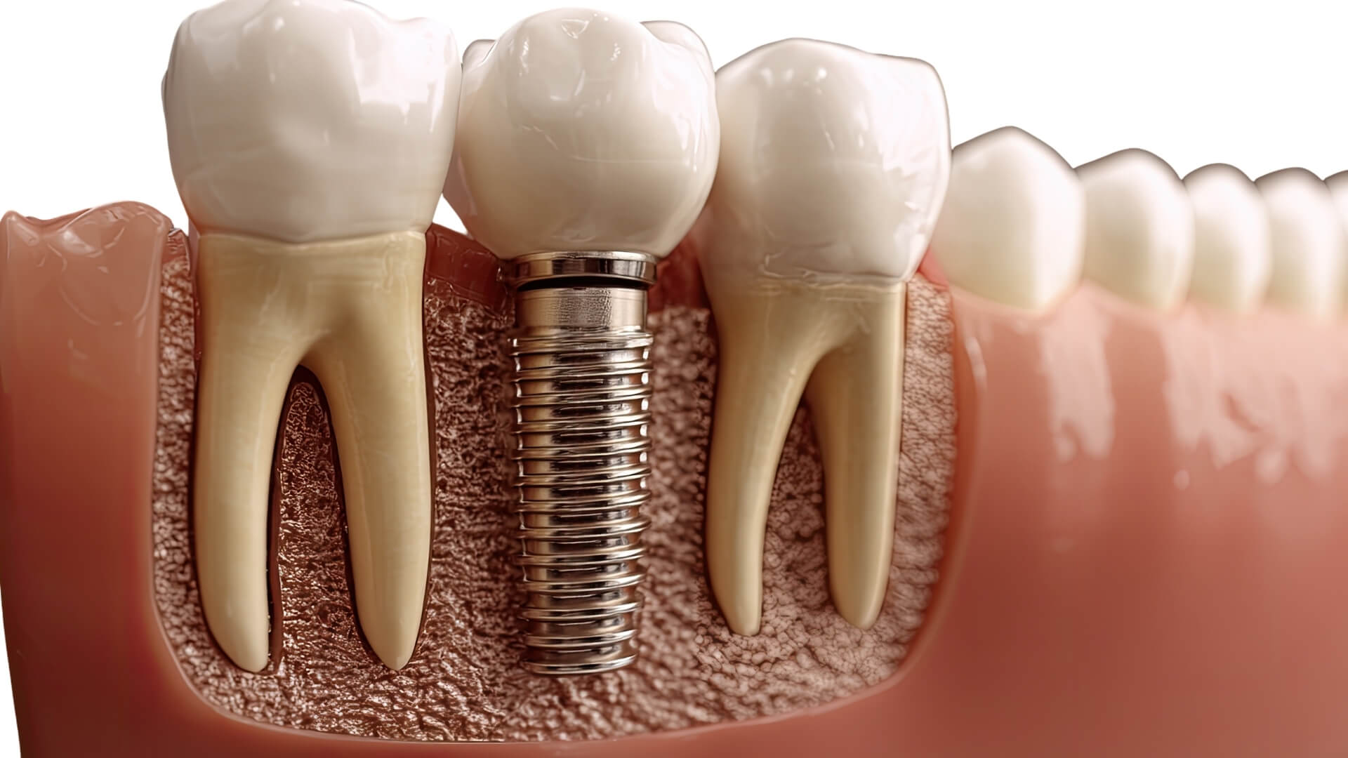 implant Tedavisi Nedir?