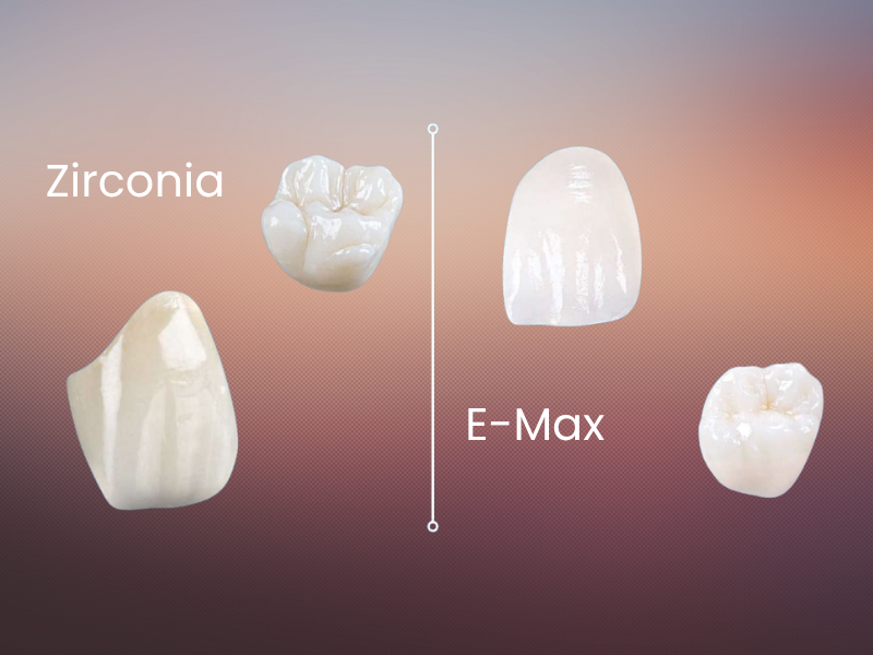 Zirkonyum Kaplama mı E-max mi? Estetik Beklentide Doğru Seçim Nasıl Yapılır?