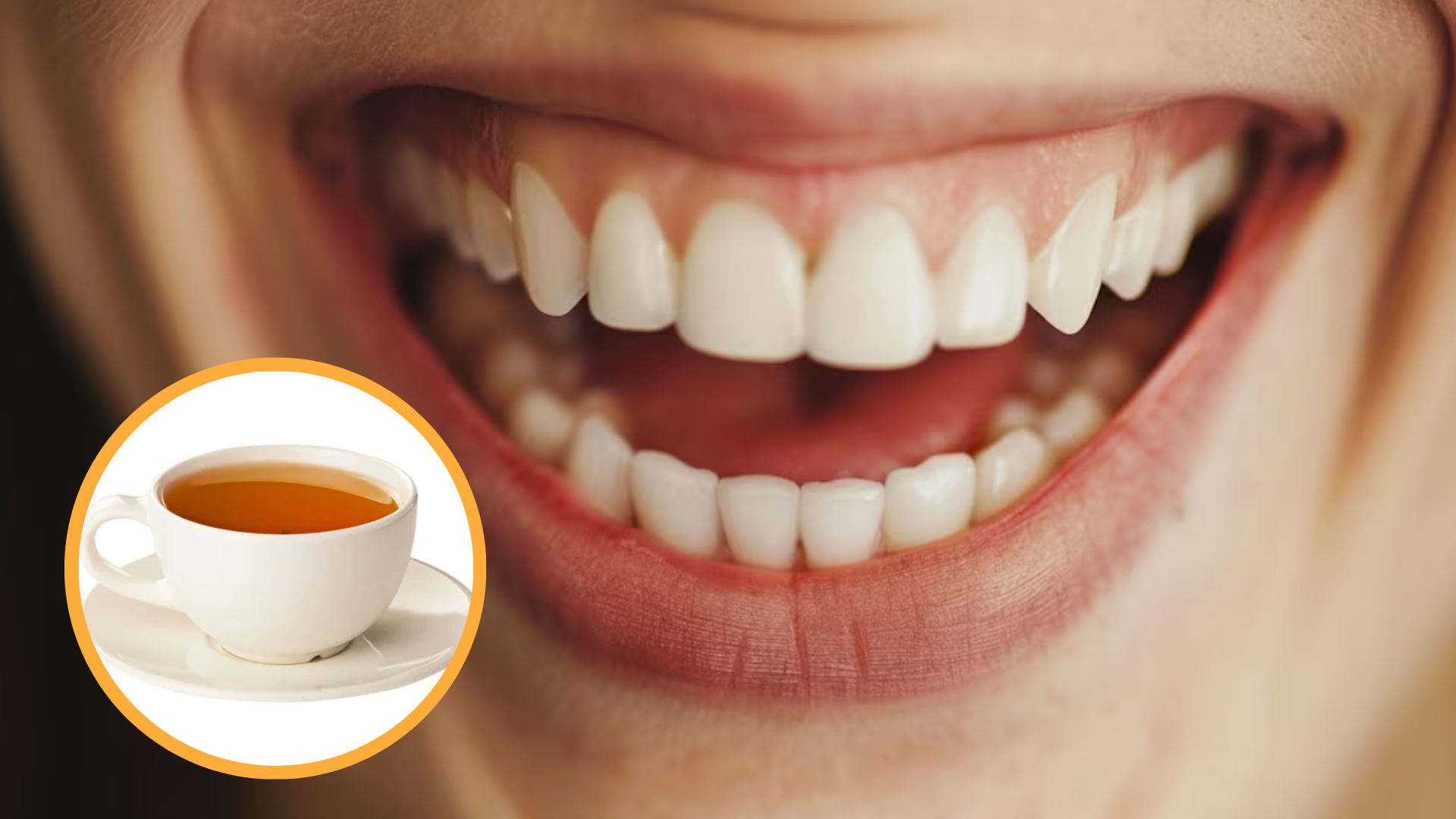 Bonding Sonrası Çay, Kahve ve Renkli Gıdalar: İlk Günlerde Nelere Dikkat Etmeli?