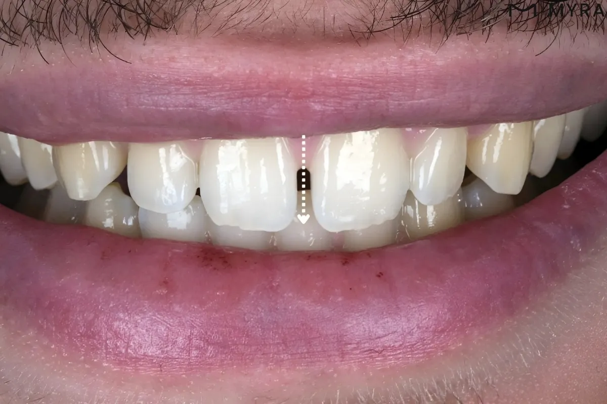 Ayrık Ön Dişlerin Kapatılmasında Bonding mi Ortodonti mi Daha Uygun?