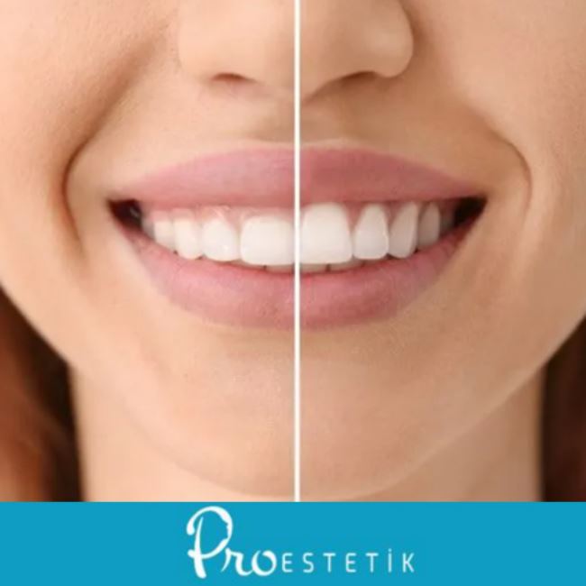 Gülerken Diş Etlerinin Görünmesi Tedavisi | (Gummy Smile)