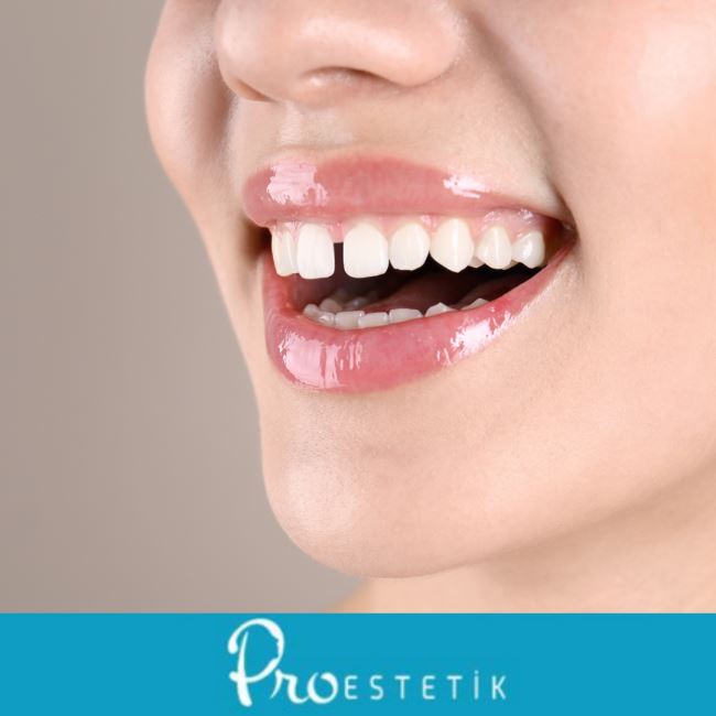 Diastema (Ayrık Diş) Nedir? Tedavi Yöntemleri Nelerdir?