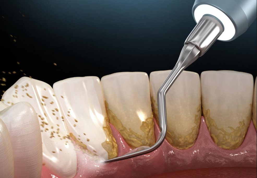 Diş Taşı Nasıl Tedavi Edilir?