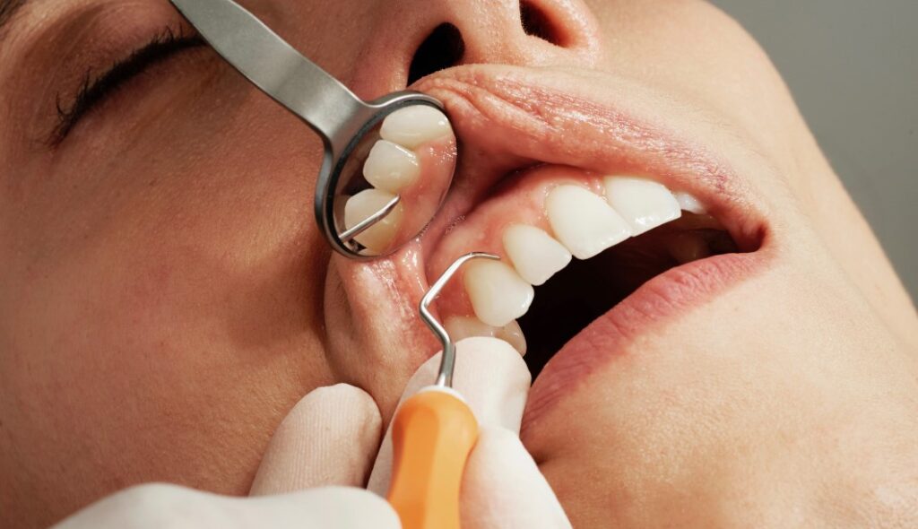 Diş Taşı Tedavisi