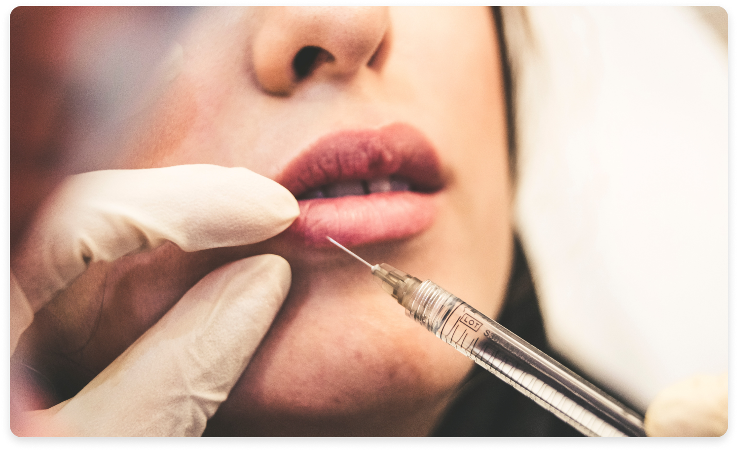 Lip Filler Injections