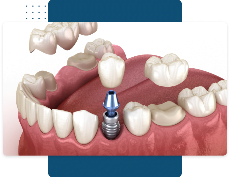 Izmir Dental Implants