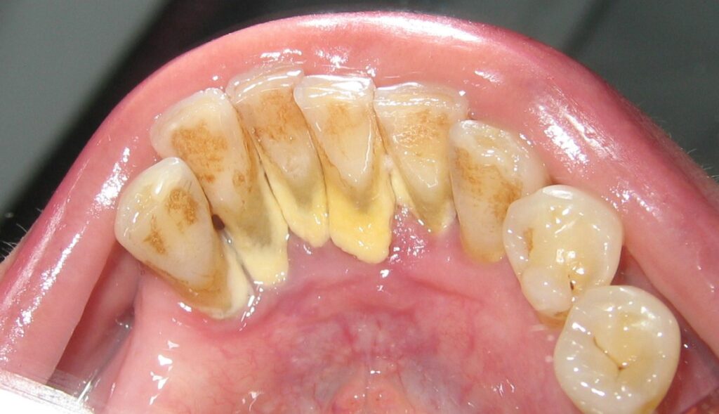 What Causes Dental Calculus?