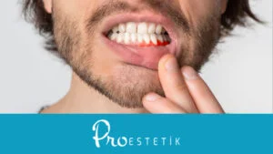 Warum fällt eine Zahnfüllung aus? Die Top 10 Fehler nach dem Füllen -  Proestetik