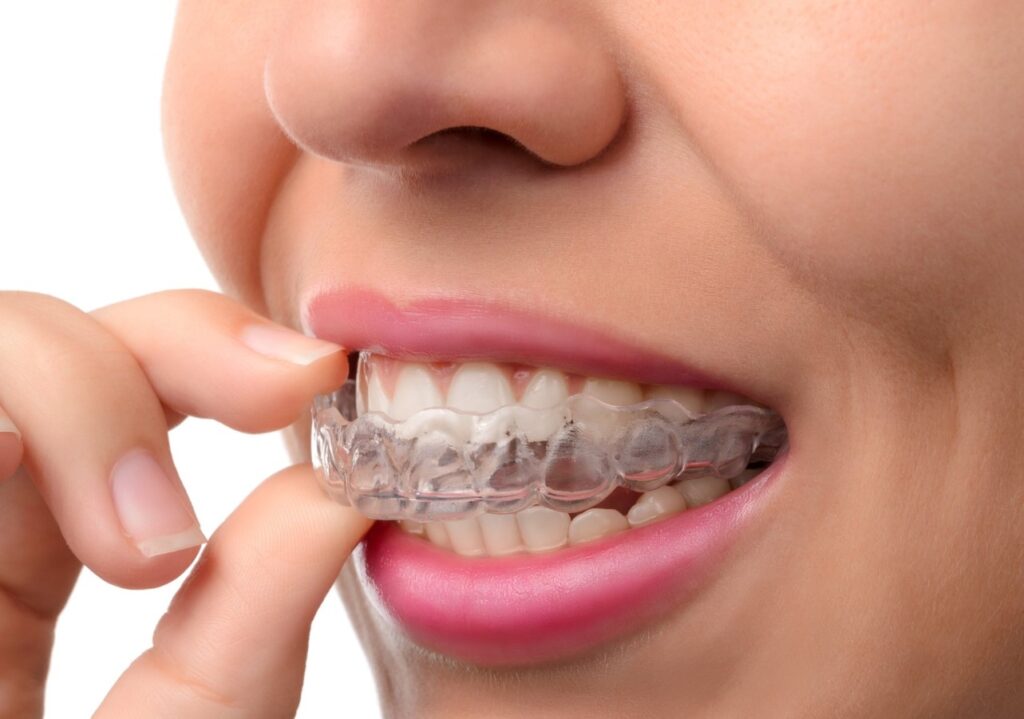 transparent dental plaque