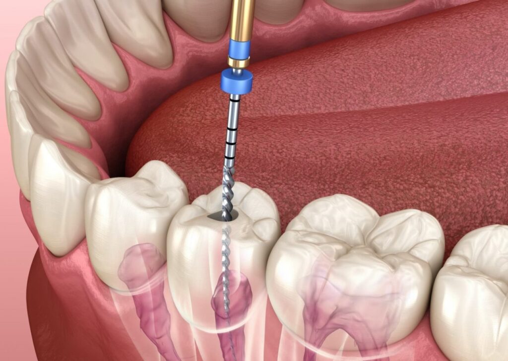 How is root canal treatment done