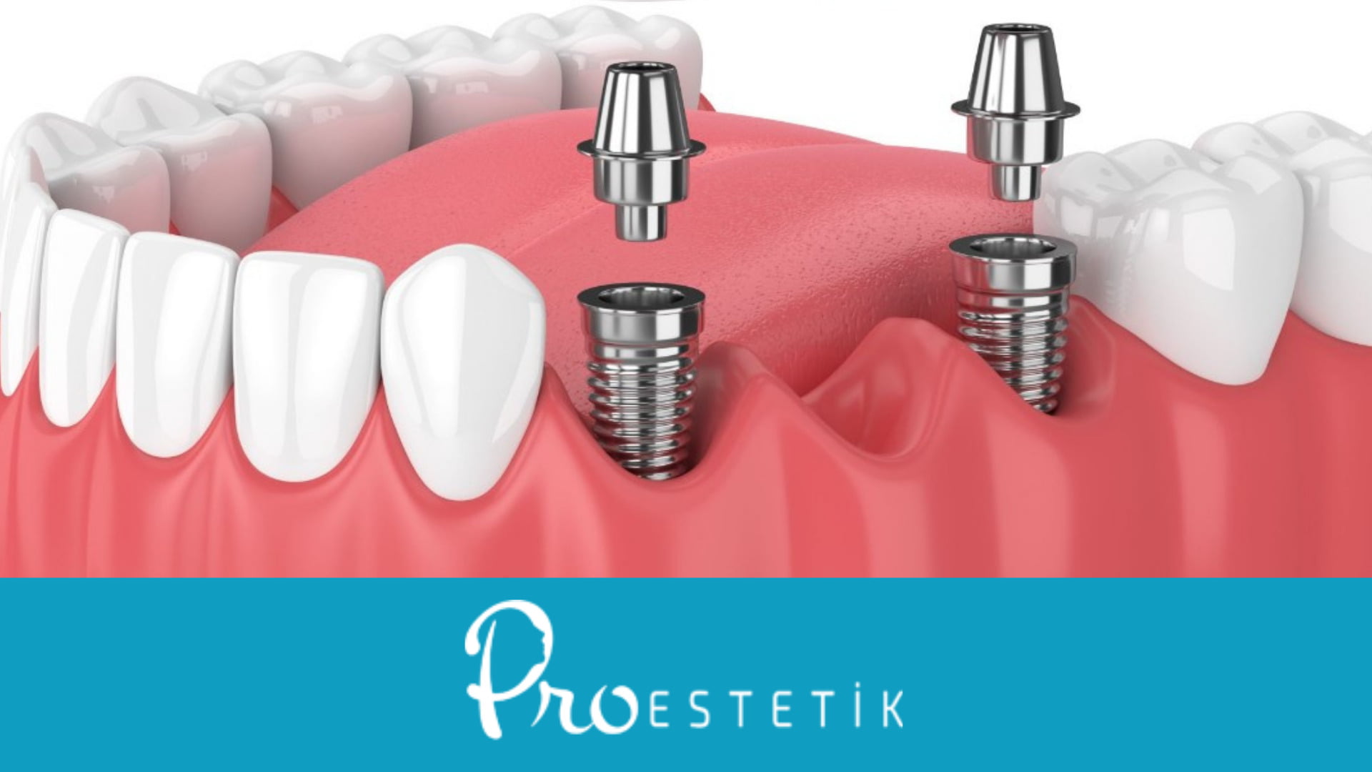 German Dental İmplant Brands – Top 5 Implant Brands