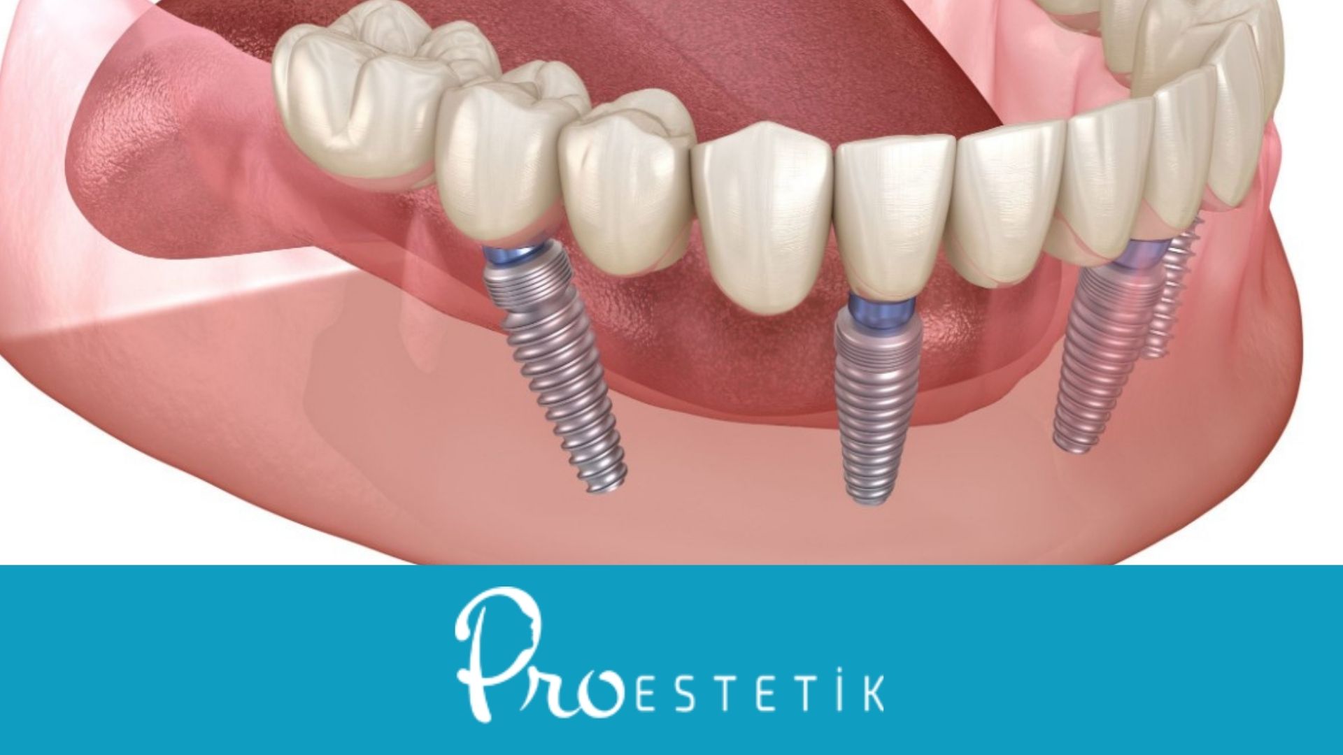 All On 4 Dental Implants – What Are The Benefits?