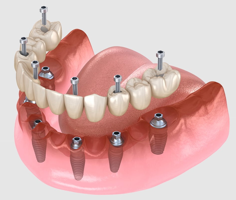all on 6 implant