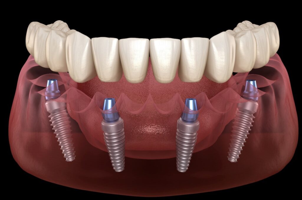 all on four dental implant technique