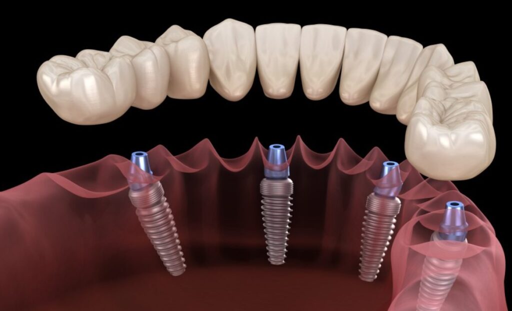 benefits of all on four dental implants