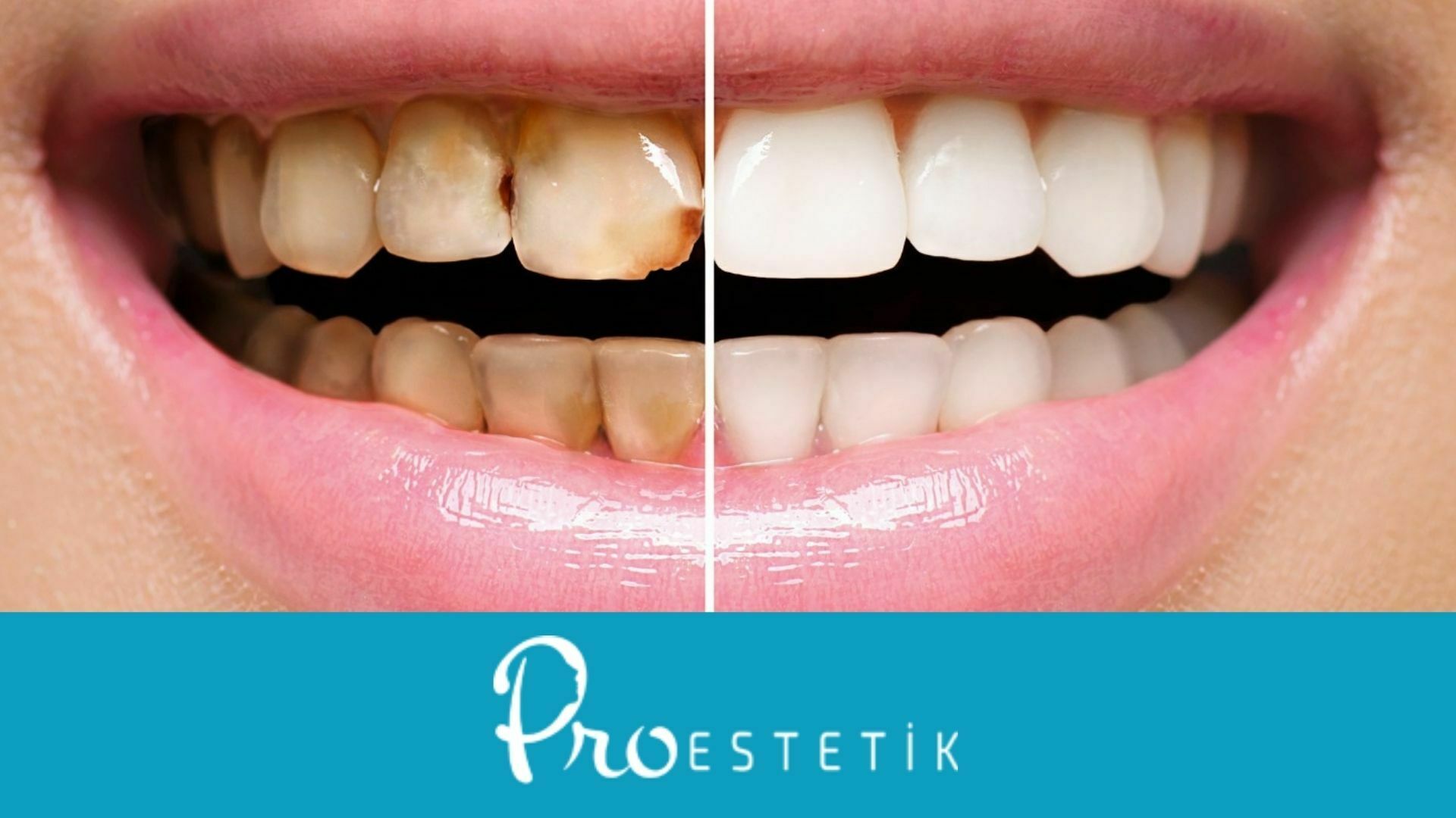 What Is Restorative Dentistry Procedures Treatments Proestetik