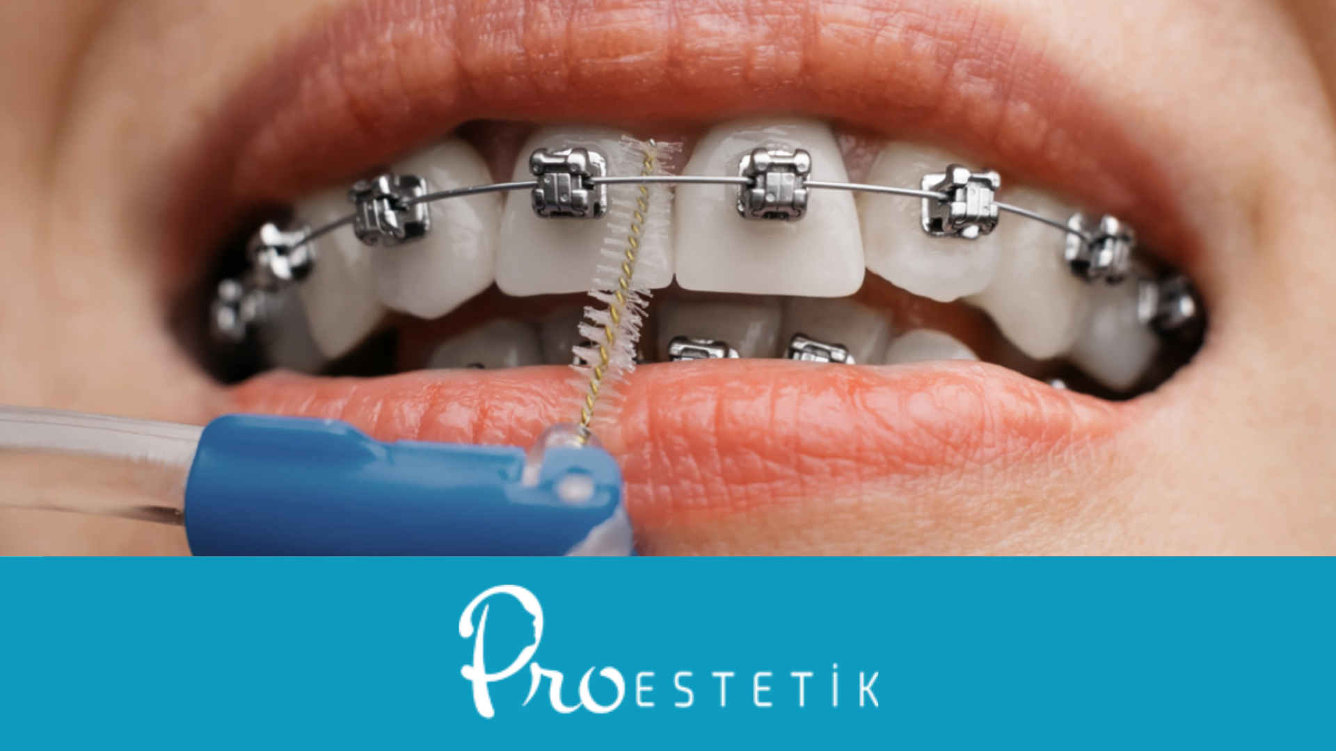 Ortodonti Nedir? Tedavi Nasıl Uygulanır?