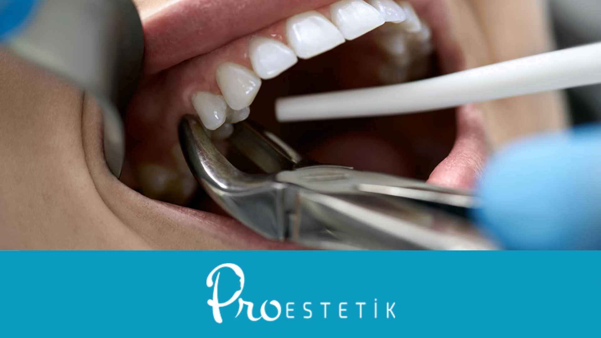 After Tooth Extraction: How to Take Care of Your Mouth