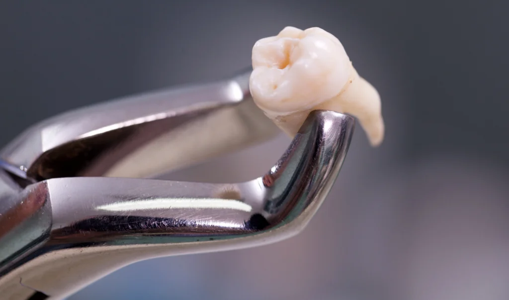 Diş Çekimi Nedir? Nasıl Yapılır? Tüm Detaylar!