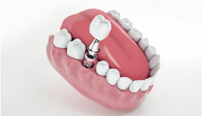 diş implant çeşitleri