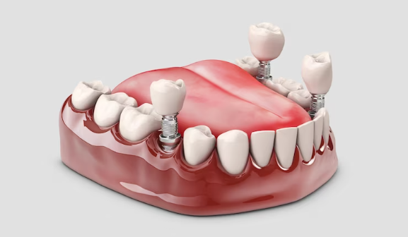 diş implant çeşitleri