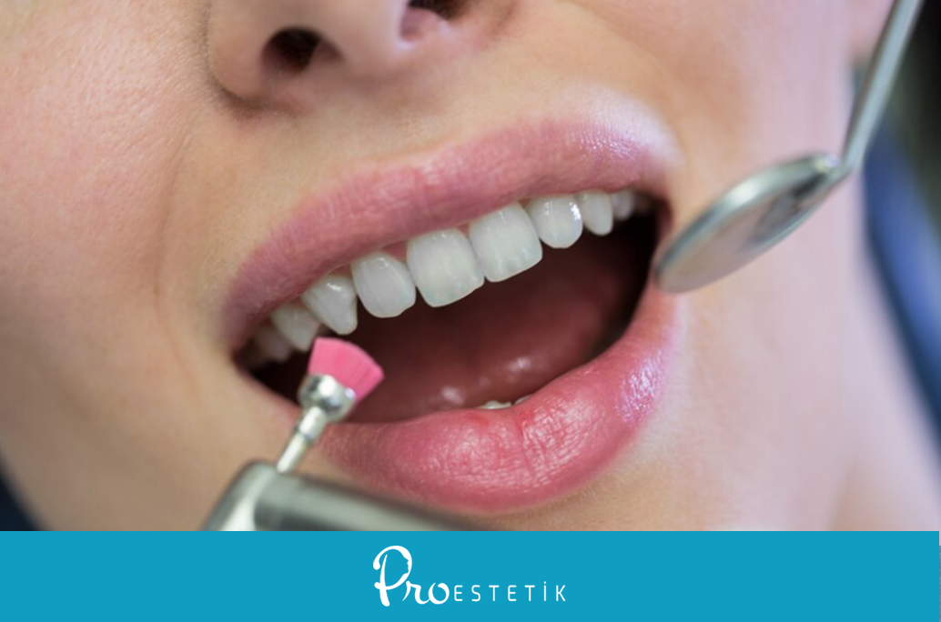 Gingivektomi Nedir Nasıl Yapılır? Estetik Diş Tedavisi
