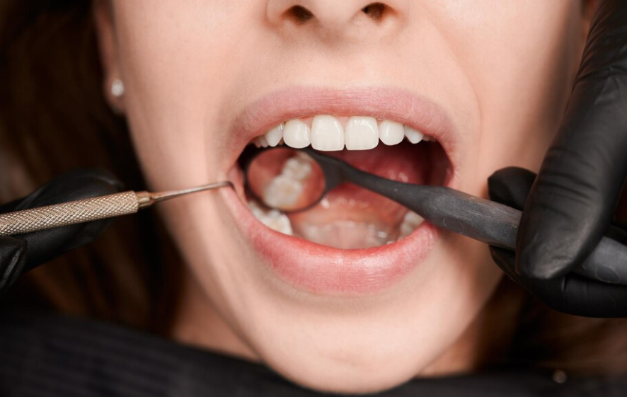 Ön Diş Kaplama Nasıl Yapılır ve Çeşitleri Nelerdir?