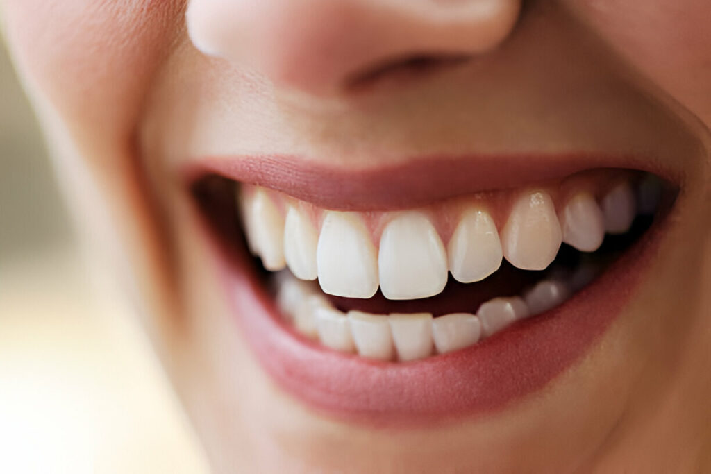 Diş Eti Beyazlaması Nedir, Tedavisi Nasıl Yapılır?
