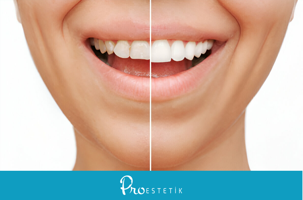 Welches ist die beste Zahnverblendung? | 8 wichtige Auswahlkriterien!
