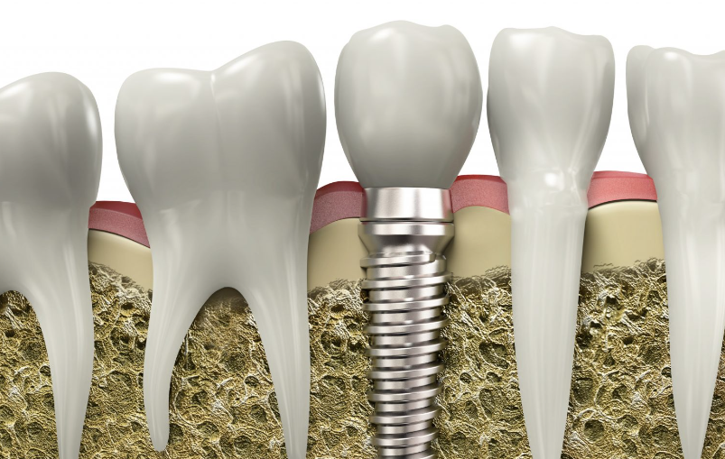 en iyi implant markaları
