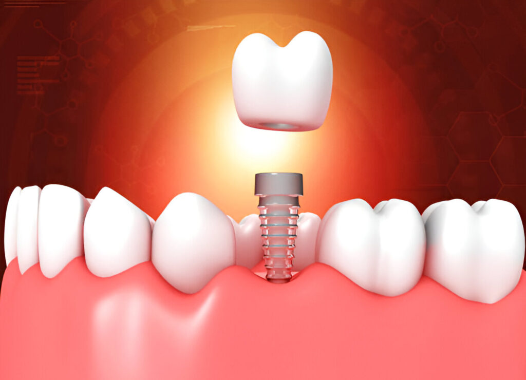 Abutment