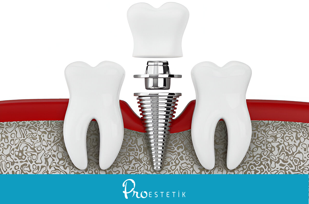 Was ist ein Abutment? Welche Arten von Abutments gibt es? Alle Details!