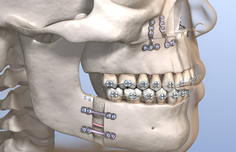 Çift Çene Ameliyatı Nedir?