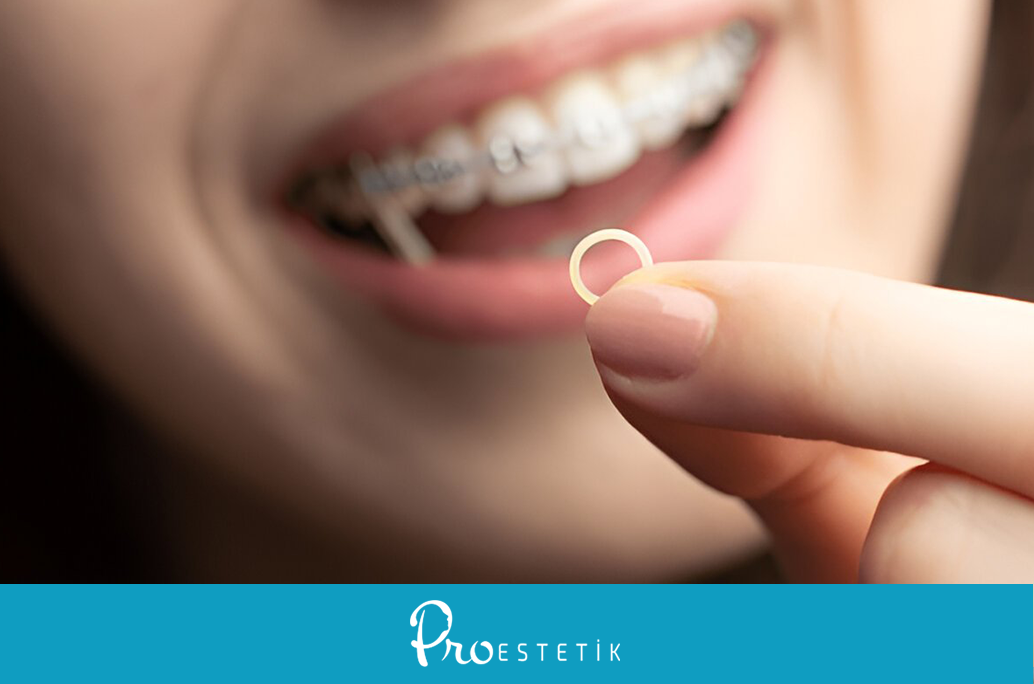 How Many Months Should Orthodontic Rubber Bands Be Worn? Points to Pay Attention To!